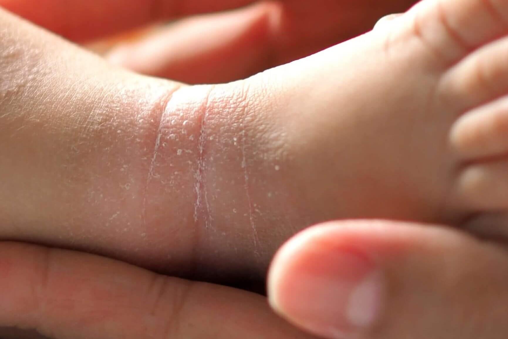 Które choroby skóry mogą być dziedziczne?